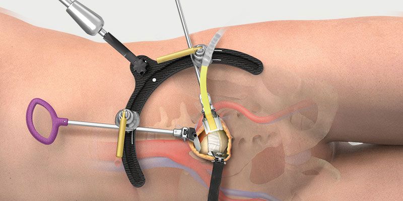 Door de operatie in zijligging te doen, kunnen er tijdens diezelfde ingreep schroeven geplaatst worden in de wervels via 2 kleine insneden in de rug, zonder daarbij de spieren te kwetsen.